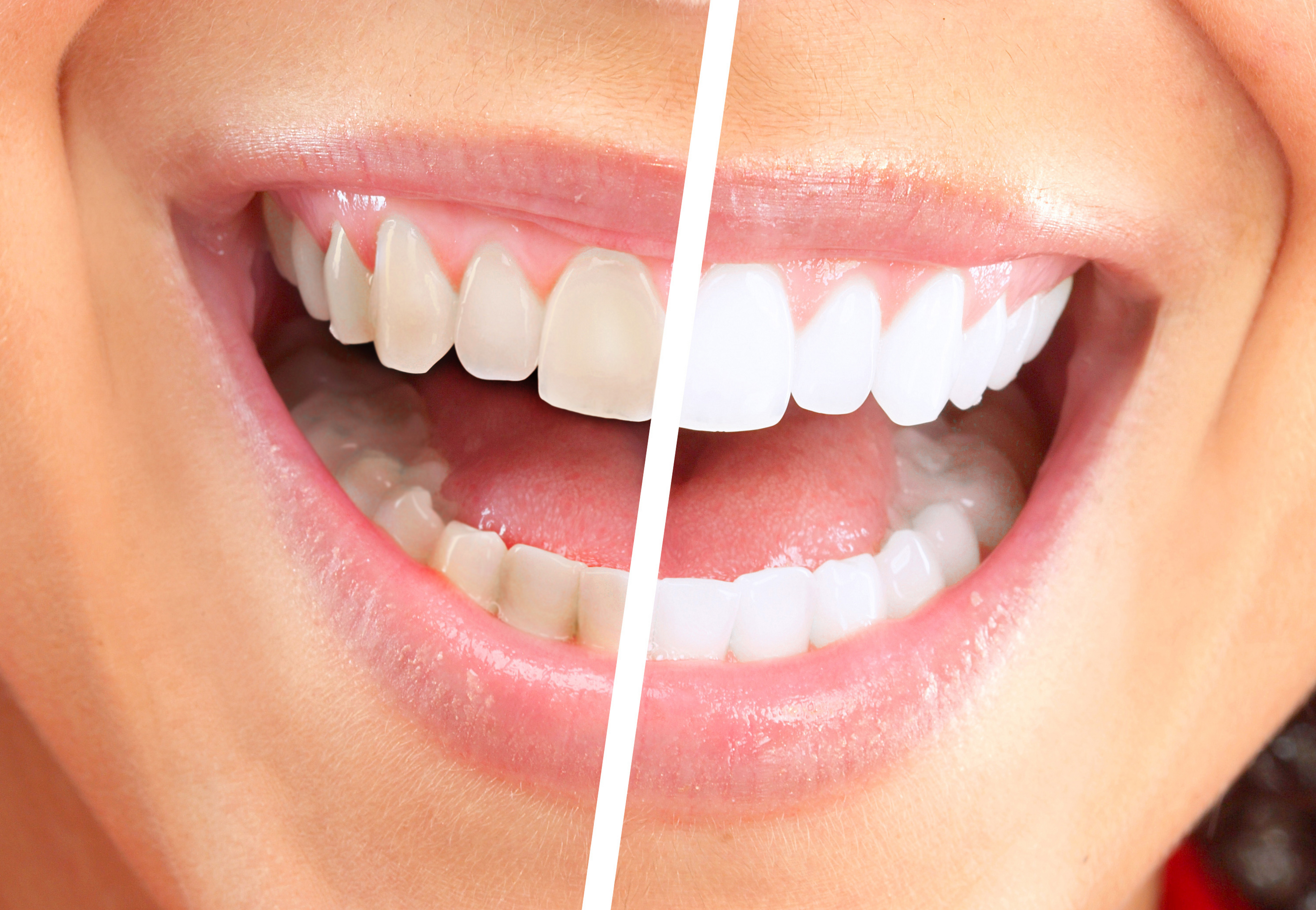Teeth Whitening Forestbrook Dental Markham Dentist Ontario