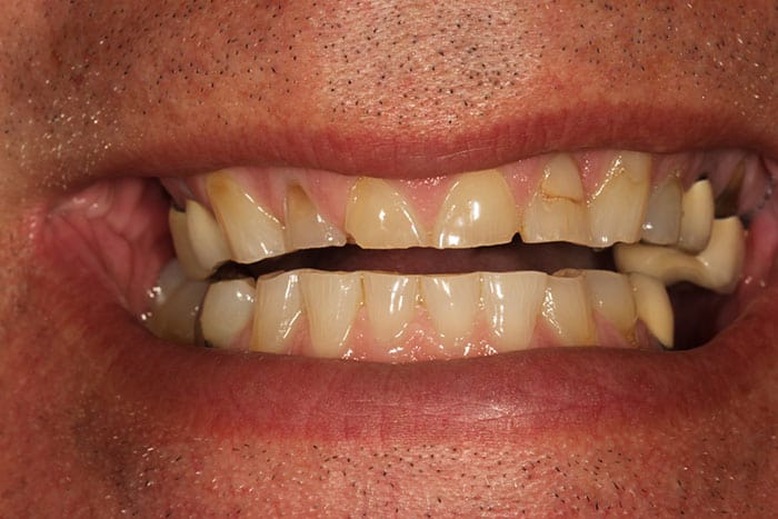 Markham Dentist - Forestbrook Dental - Occlusal disease