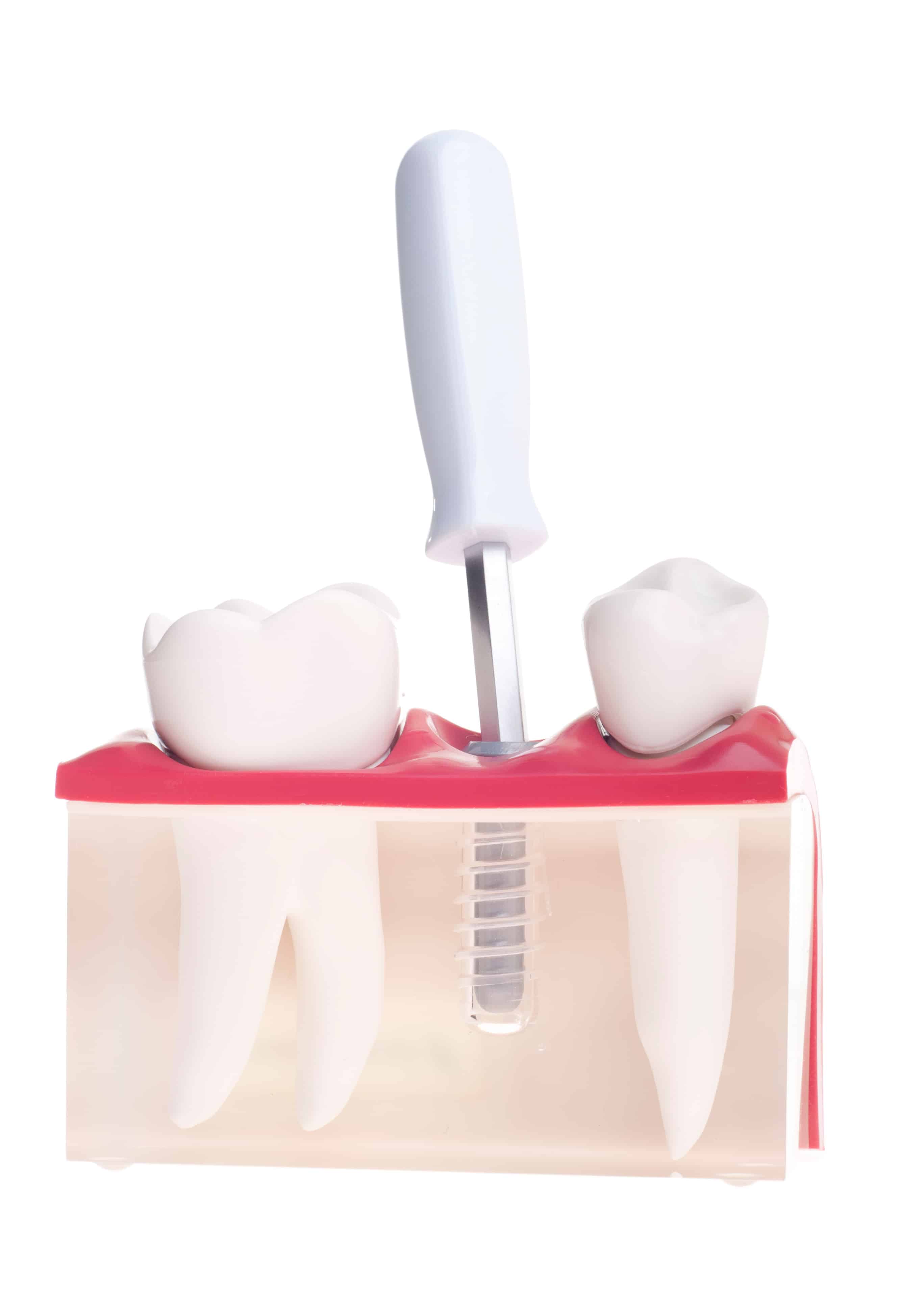 dental implants - Markham Dentist - Forestbrook Dental - Dental Impants