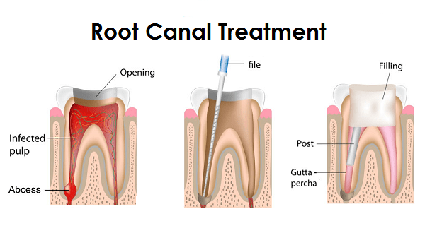 endodontic treatment root canal