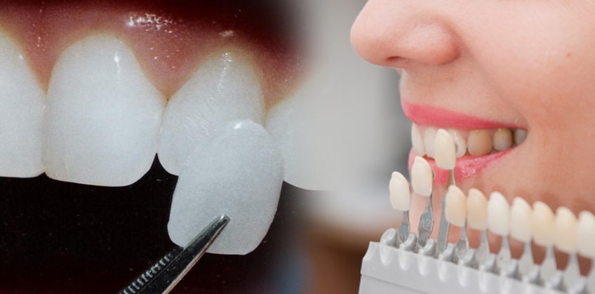 Markham Dentist - Forestbrook Dental - Dental Veneers