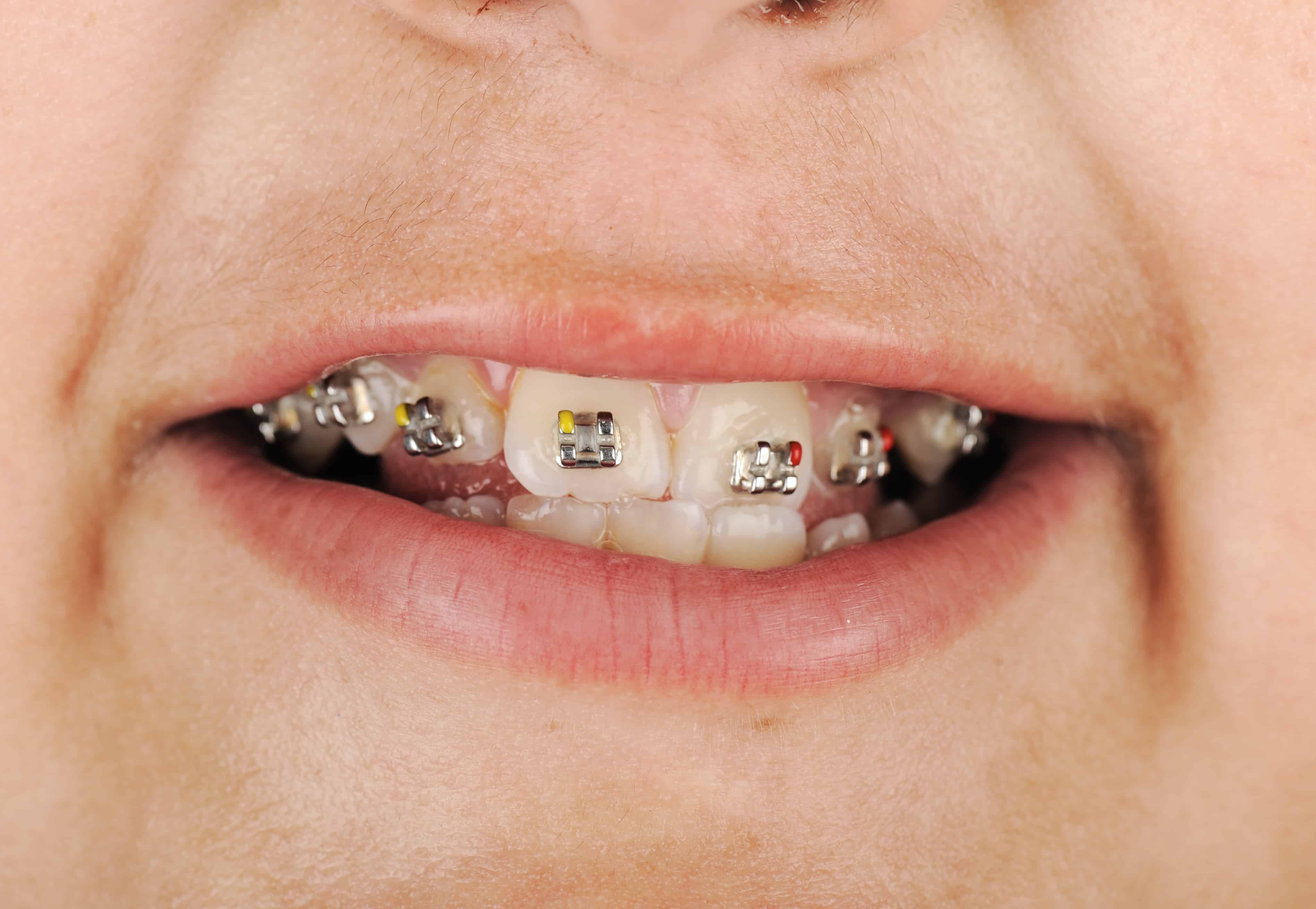 kid with braces by forestbrook dental