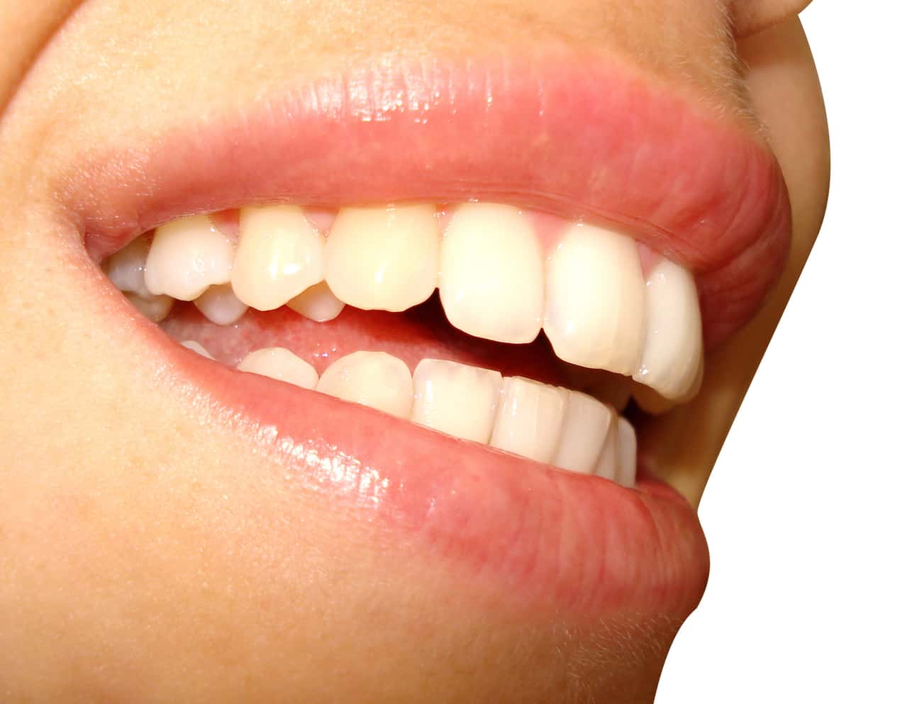 Markham Dentist - Forestbrook Dental - Dental Crowns