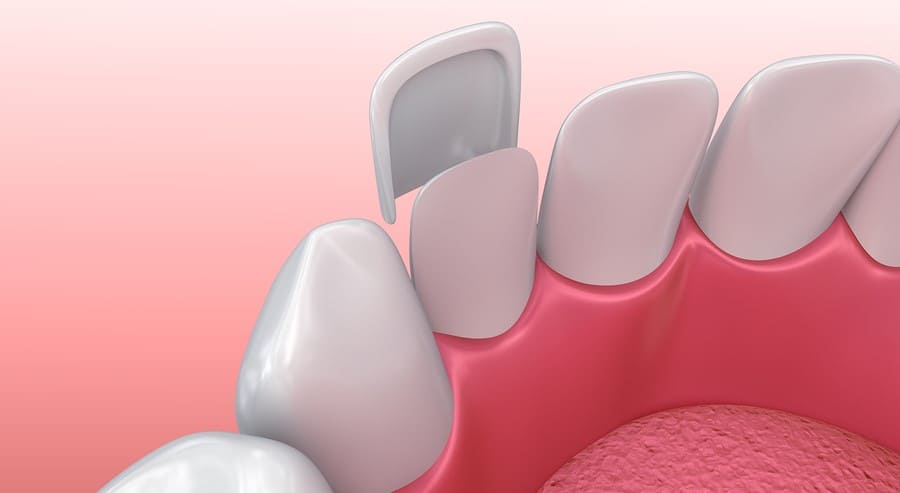 Teeth Veneers Markham - Markham Dentist - Forestbrook Dental