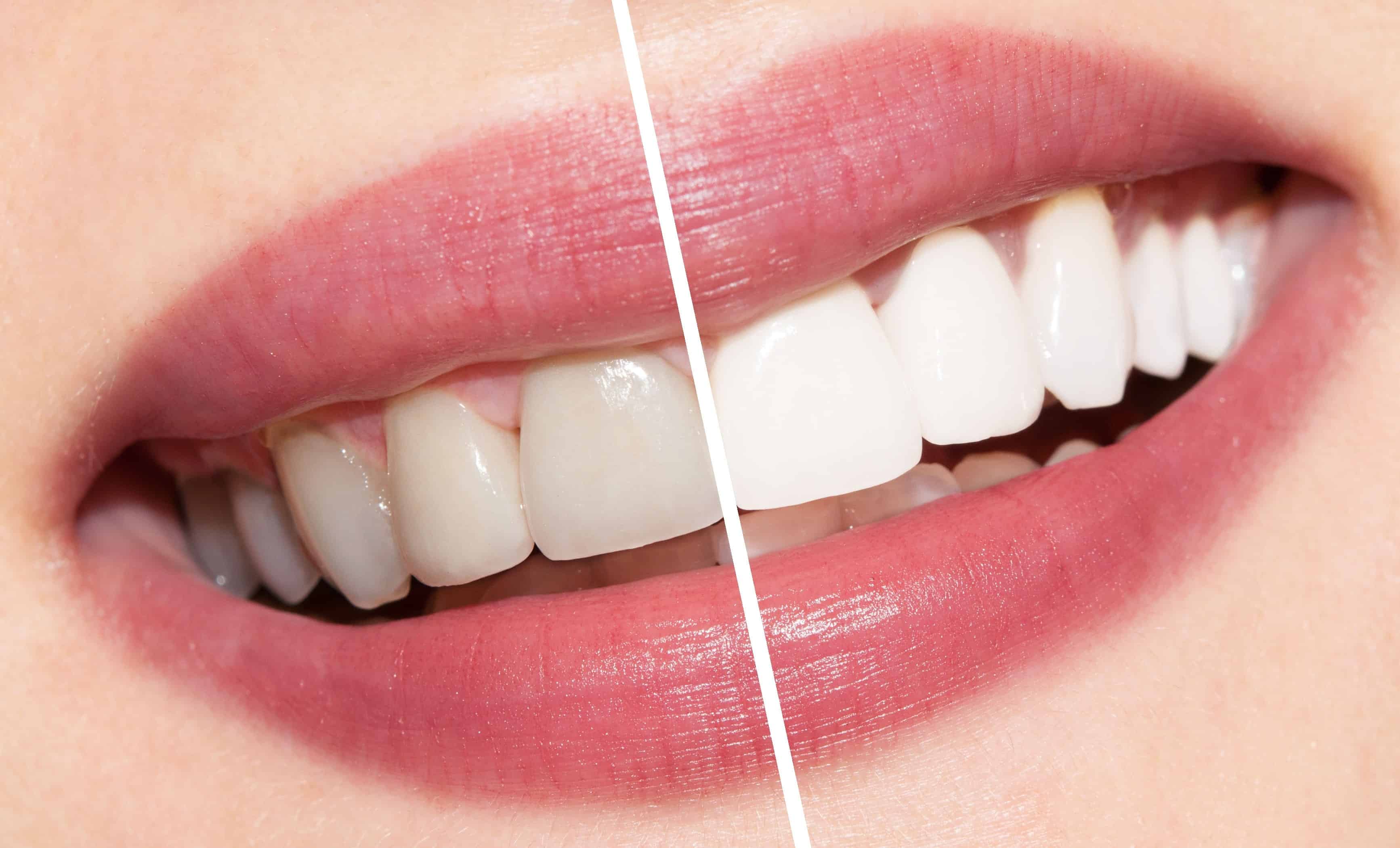 teeth whitening by forestbrook dental