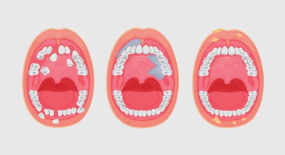 Oral Cancer symptoms Markham - Markham Dentist - Forestbrook Dental