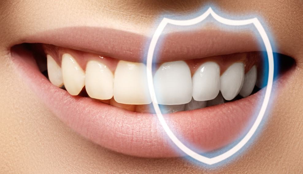 Teeth Bonding Markham - Markham Dentist - Forestbrook Dental