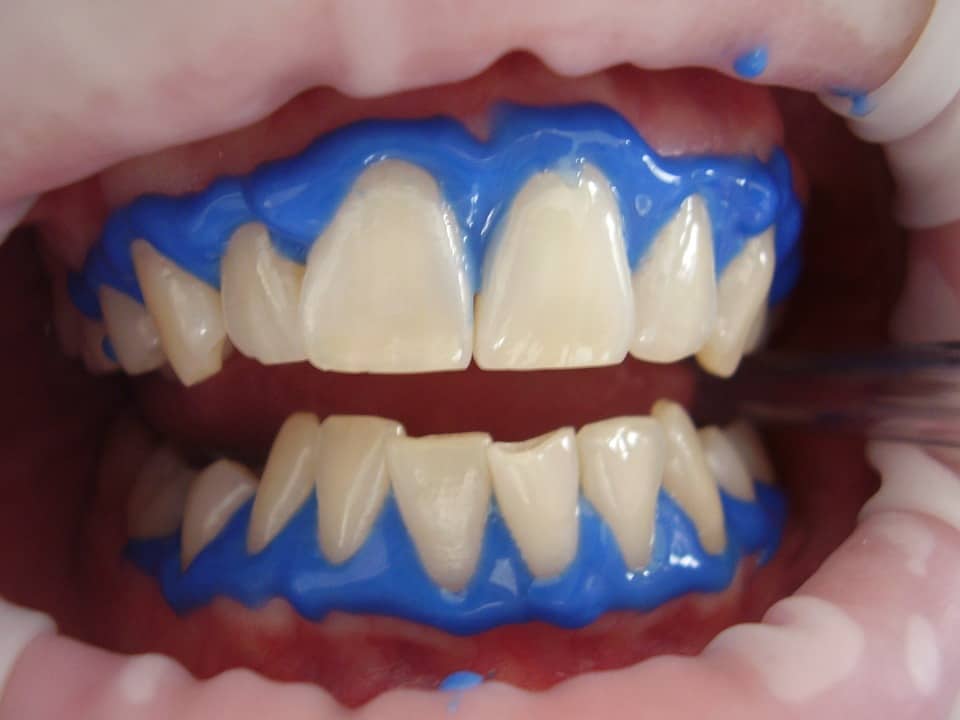 laser teeth whitening 2 - Markham dentist - Forestbrook Dental Care