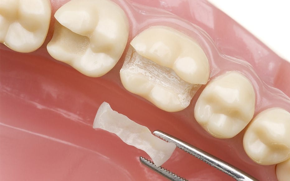 Safe Dental Fillings in Markham - Forestbrook Dental Clinic