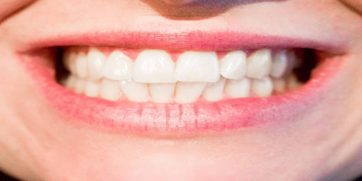 Dental veneers smile - Forestbrook Dental - Family and Cosmetic Dentistry - Markham Dentist