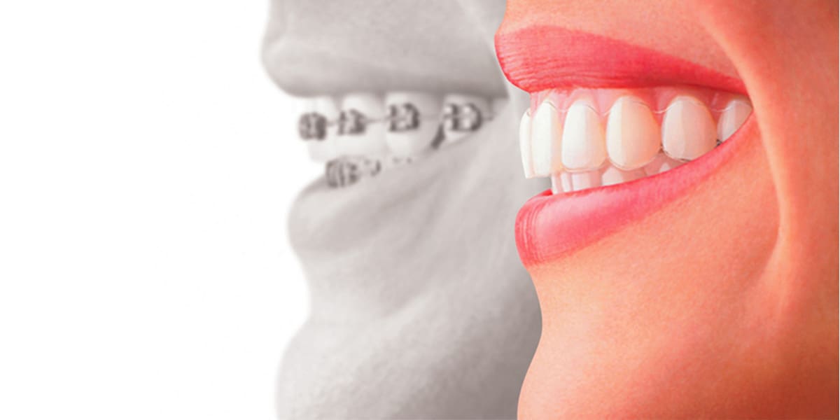 Choose The Best Type Of Invisalign To Restore Your Smile - Forestbrook Dental - Markham Dentist