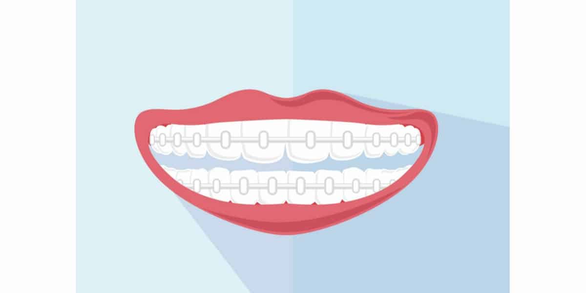 Here Is How You Deal With The Drawback Of Ceramic Braces - Forestbrook Dental - Markham Dentist