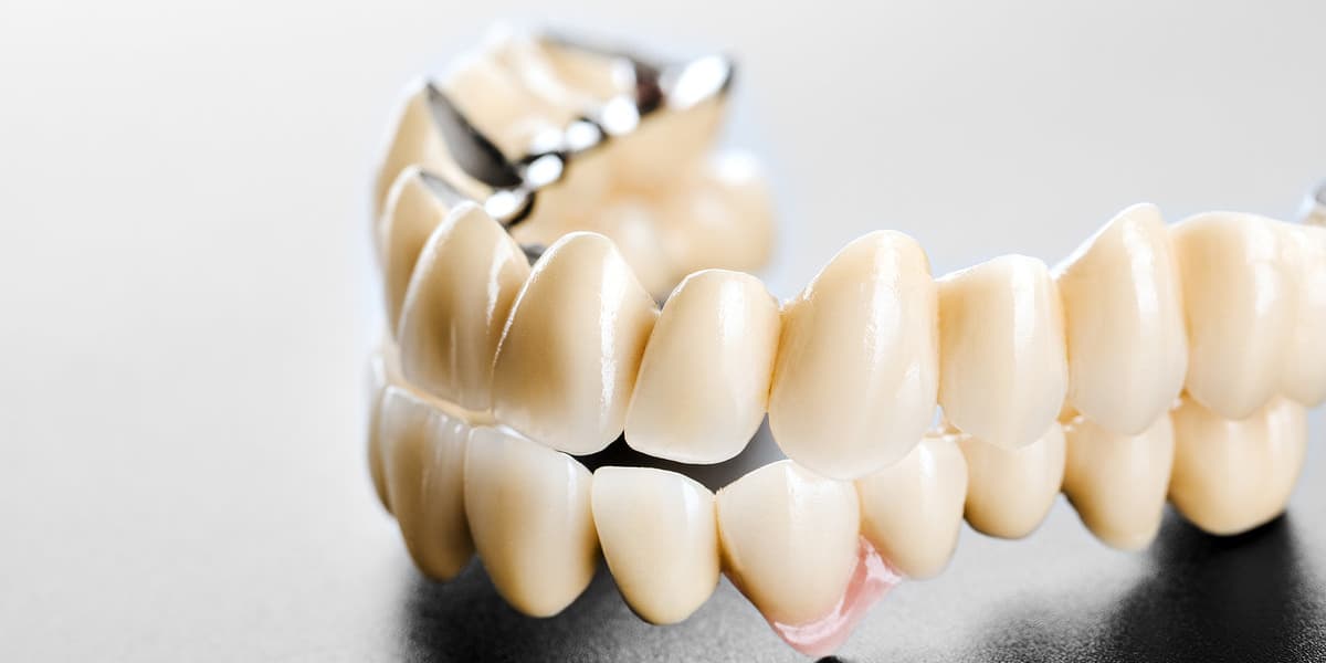 dental bridge - Forestbrook Dental - Family and Cosmetic Dentistry - Markham Dentist