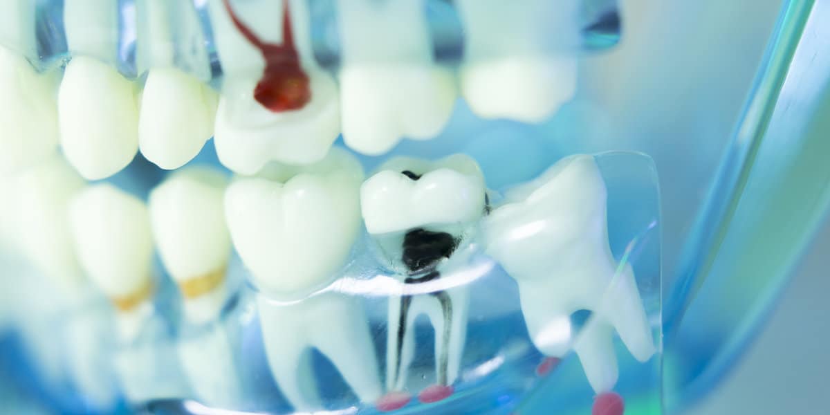 Dentist model showing root canal decay and inflammation - Forestbrook Dental - Markham Dentist