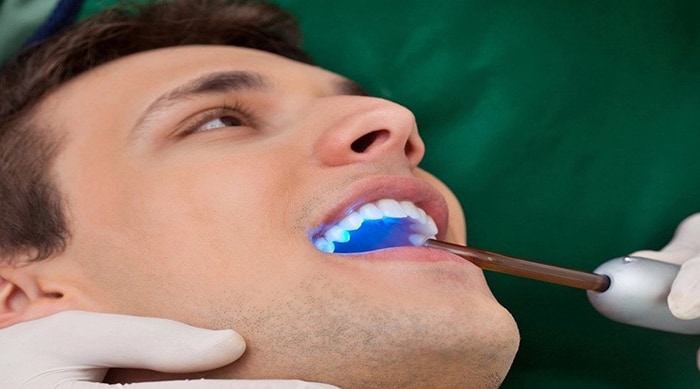 dental sealants - Forestbrook Dental