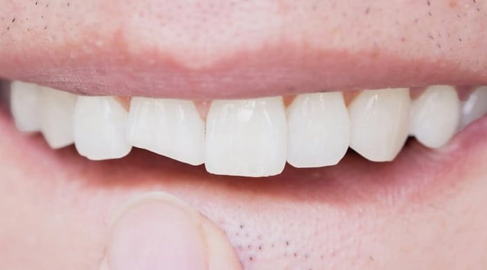 broken tooth - Forestbrook Dental