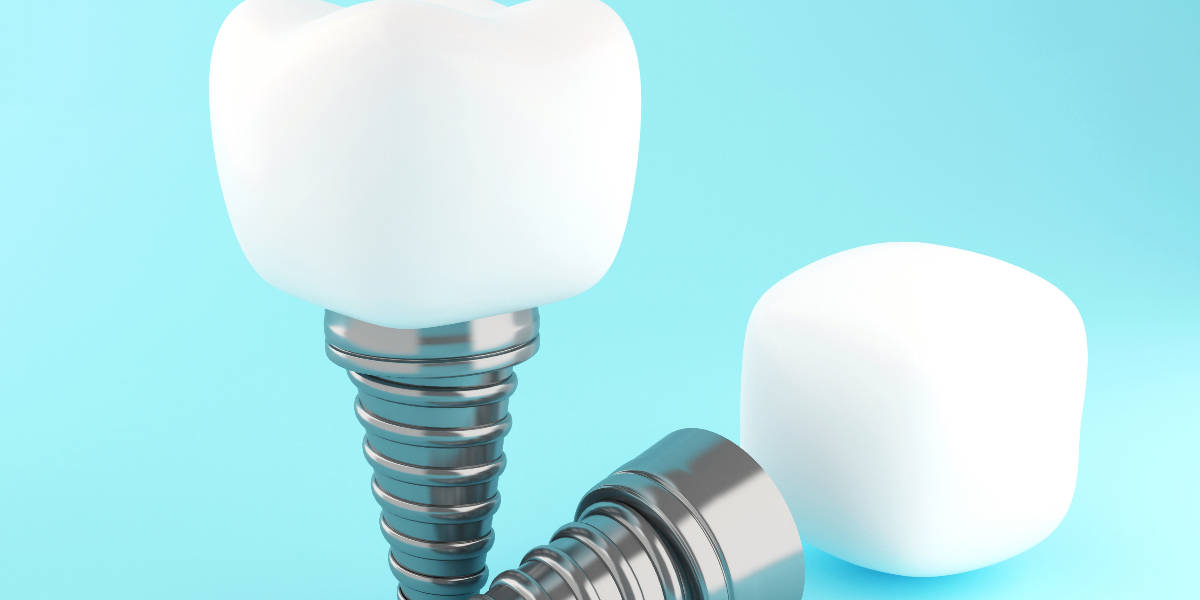 Tooth implant in Markham
