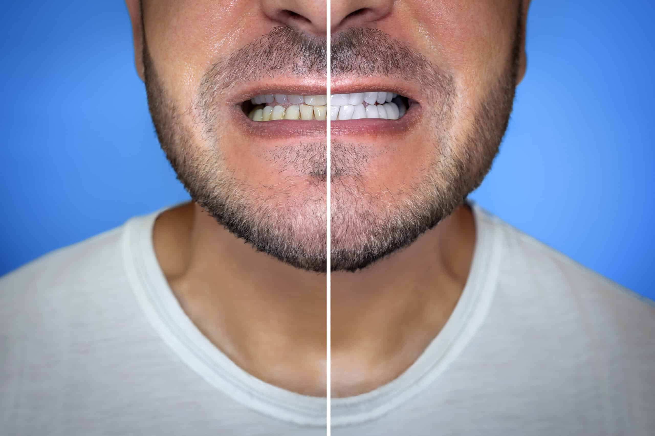 Unveiling Your Dream Smile: Veneers Before and After